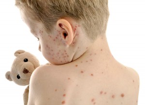 Vaccinare tutti i bambini per la varicella? Forse no …